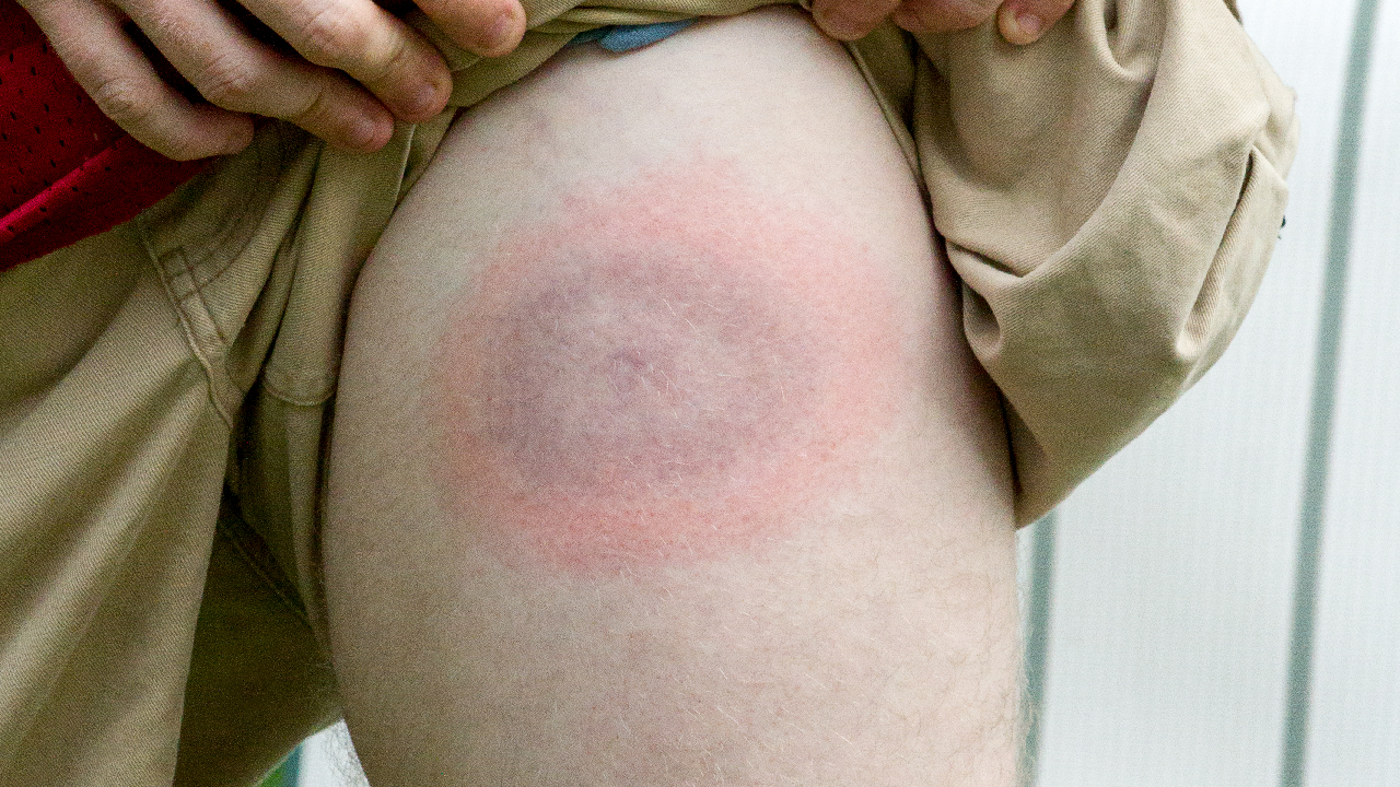 lyme-disease-summary